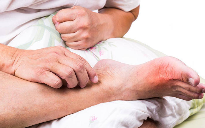 痛风发作越来越频繁了怎么办,警惕痛风高尿酸血症4大认识误区