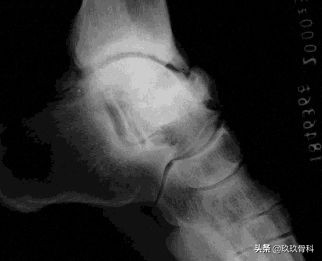 陈旧性踝关节损伤的治疗,踝关节损伤现场处理视频