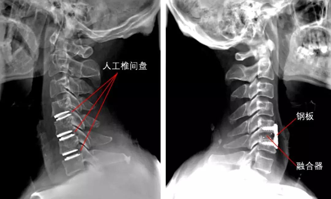颈椎病是保守治疗还是手术治疗好,颈椎病做什么手术比较安全