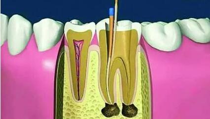 根管治疗步骤有哪些呢,根管治疗是针对什么情况