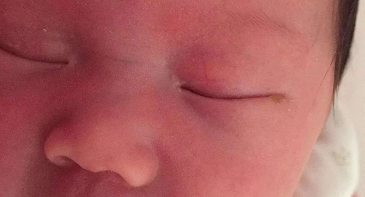 新生宝宝眼屎多什么原因,新生宝宝眼屎黄脓状怎么办