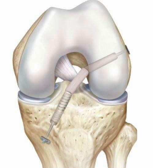 膝关节前交叉韧带修复后如何康复,前交叉韧带重建后膝盖发软