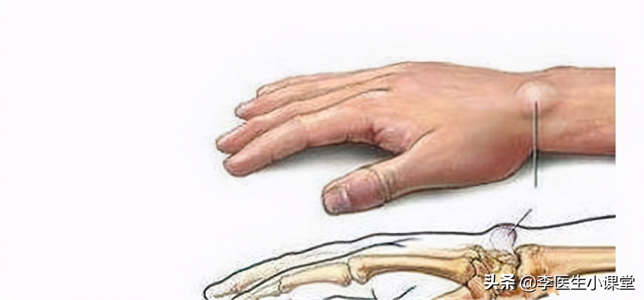 女性更年期大拇指腱鞘炎怎么治,更年期女性为什么会得腱鞘炎