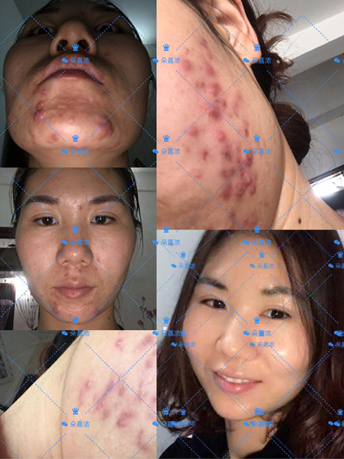 十几年战痘路，有多少辛酸泪！