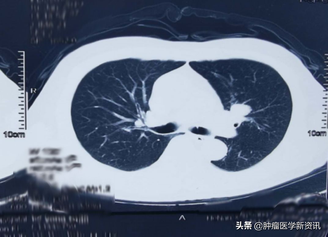 肺癌早期的6个信号中医治癌,肺癌正确的抗癌方法