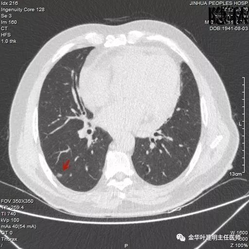 警惕-会是简单的肺大泡吗？