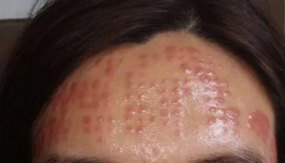 一次水光针相当于敷了1000次面膜,一次水光针等于10次补水