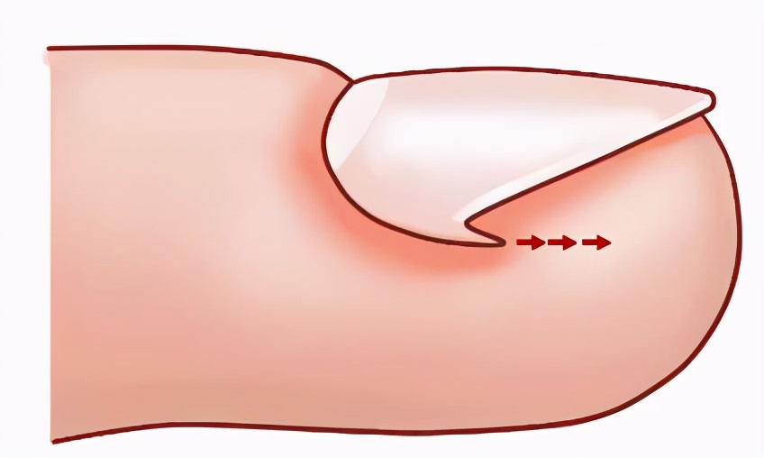 甲沟炎的处理方法视频,甲沟炎处理小视频