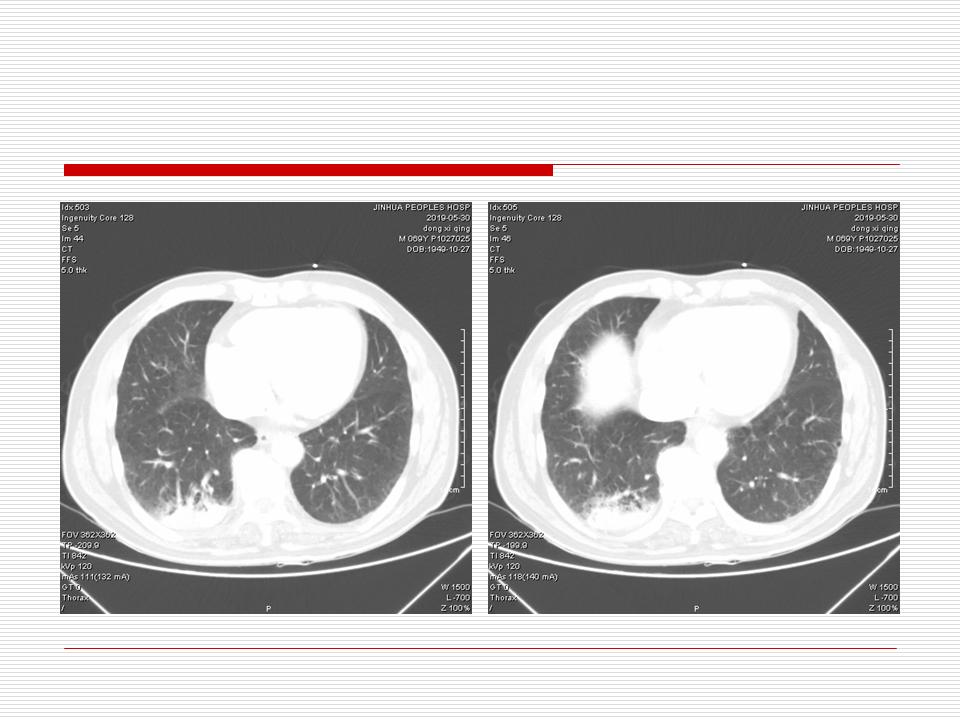 像炎症的肺癌能治好吗,医生说可能是肺癌也可能是炎症