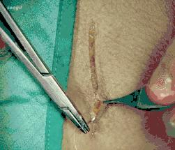 常用的手术缝合方法图,临床常见常用伤口缝合方法