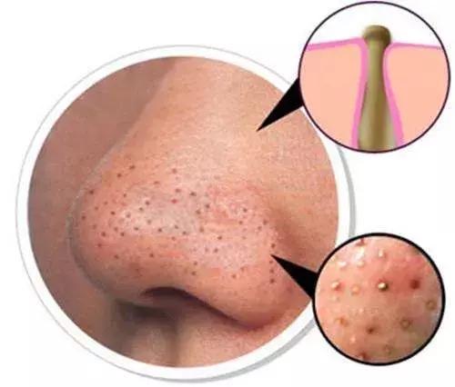 人人都会长黑头吗,好多人都长黑头吗