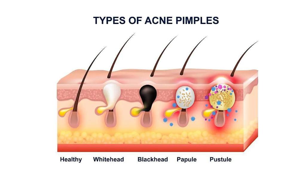 鼻子上挤出的就是螨虫吗,鼻子两边挤出白色的东西是螨虫吗