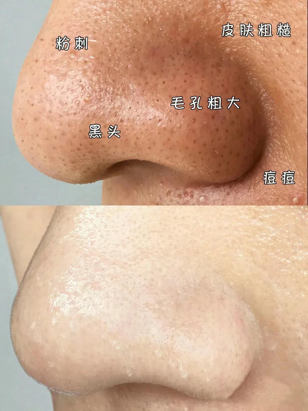 甲硝唑凝胶的使用方法祛黑头,祛黑头最好的方法目前最有效