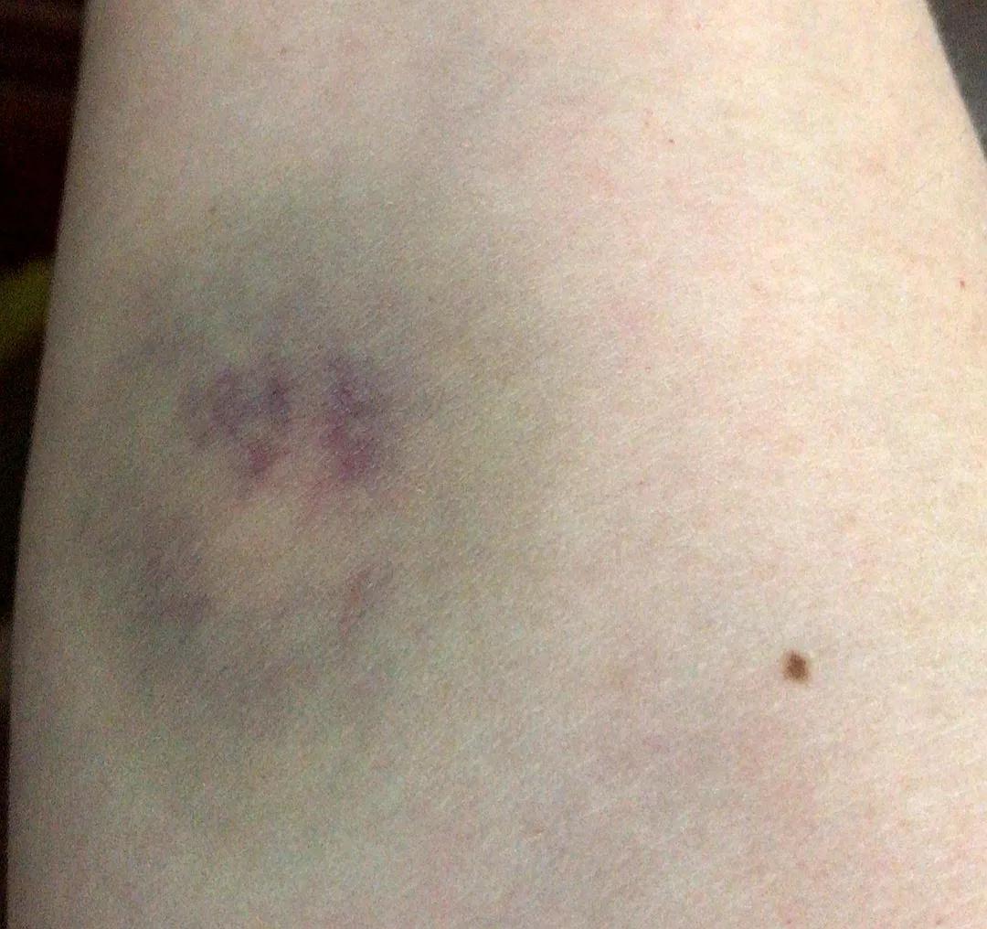 色素性紫癜性皮肤病是啥,色素性紫癜性皮肤病是什么