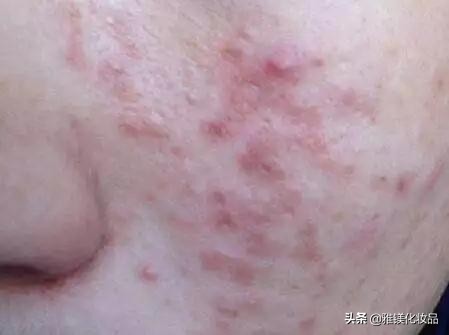 脸上部位长痘痘的原因分析图,脸上哪个部位长痘痘代表什么