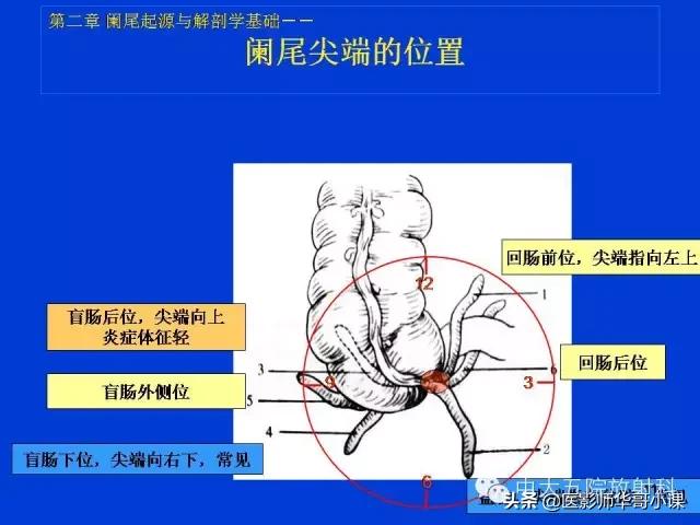 阑尾炎课件,阑尾炎的超声课件