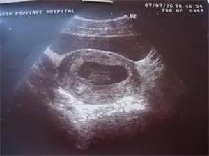 早孕期血清学筛查准确率,早孕期查哪些指标比较准确