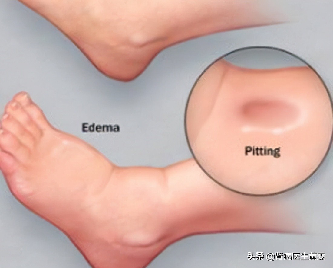 肾病消除水肿后体重会下降多少,肾病水肿看中医还是西医