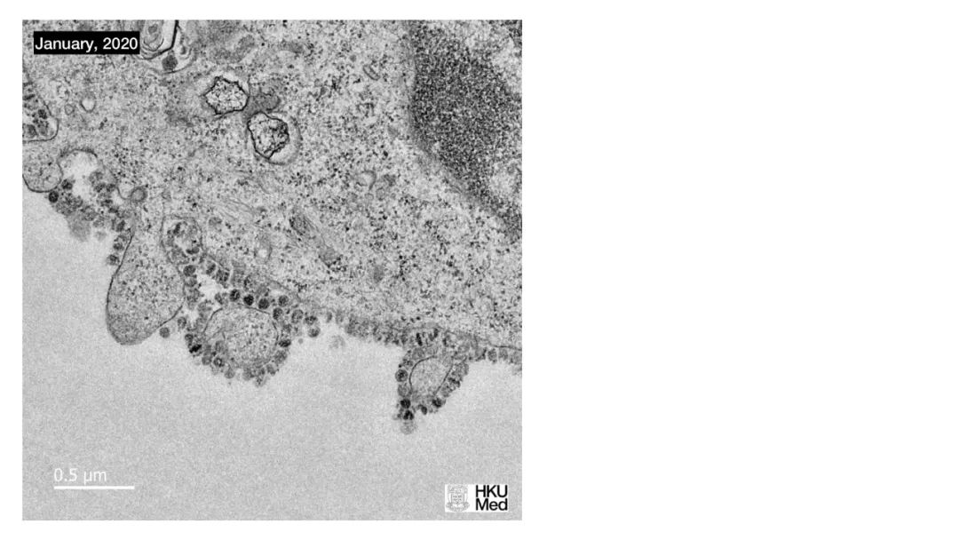 新冠病毒检测结果实验室解读,新冠病毒有哪些实验室检测方法