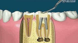 大连口腔视频,大连市口腔医院根管治疗