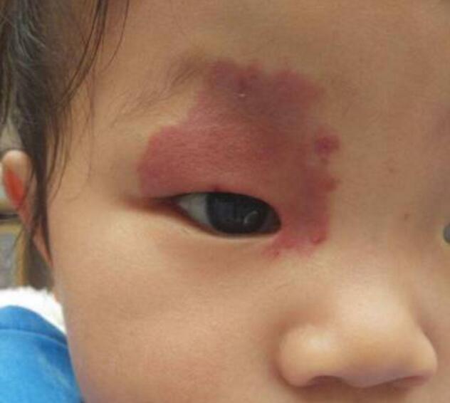 鲜红斑痣会遗传给下一代吗,母亲有鲜红斑痣会遗传给孩子吗