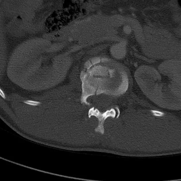 特殊骨折类型,特殊骨折体征