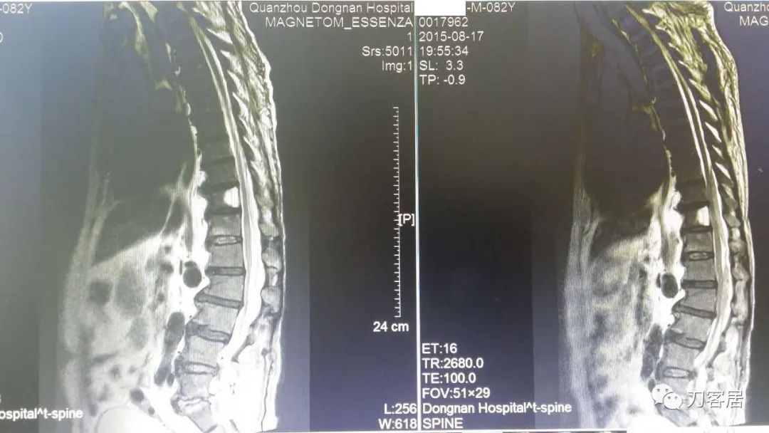 腰椎手术切掉棘突,腰突微创后出血肿