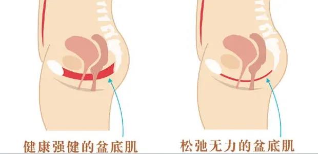 产后子宫恢复的正确方法,药流后注意什么有助于子宫恢复