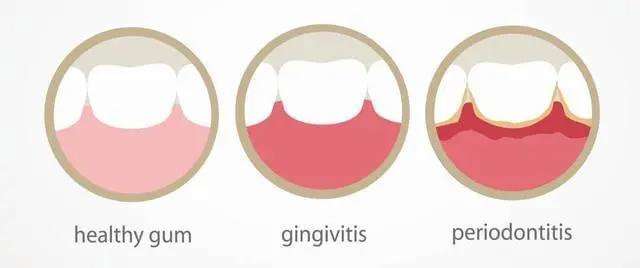 未成年缺牙不能种植牙怎么办,缺牙单色咀嚼十几年还能种植牙吗
