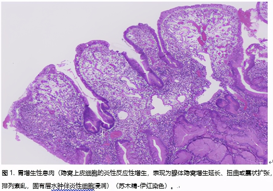 胃息肉可怕不,做胃镜查出胃里有息肉怎么办
