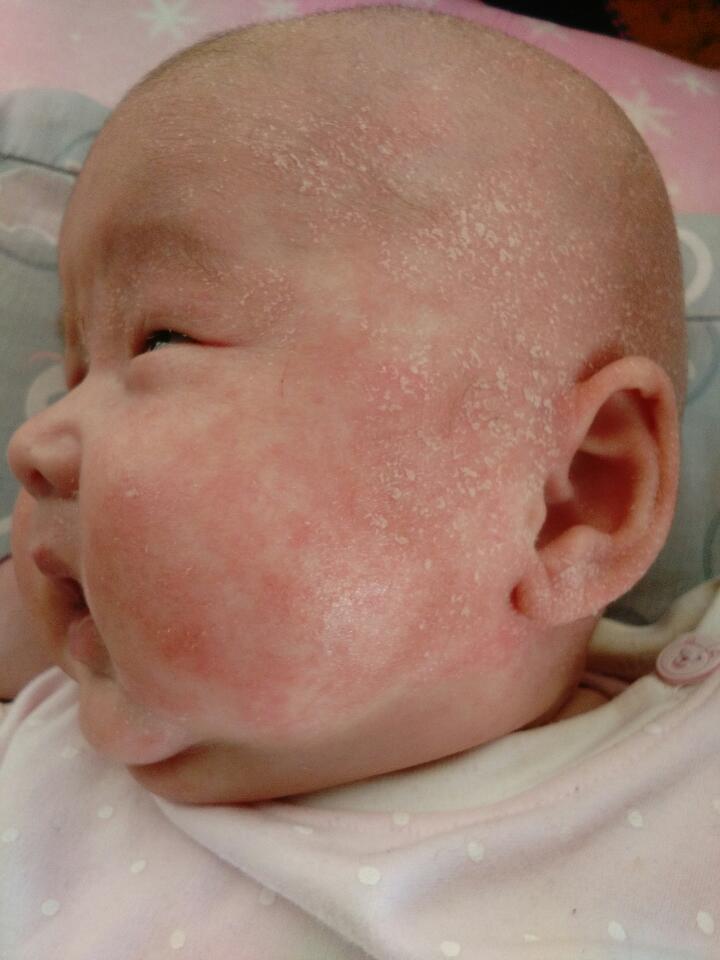 婴儿湿疹宝妈们有什么推荐,湿疹反复的宝宝宝妈怎么护理的啊