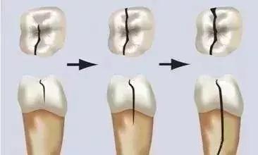 牙齿咬到硬物裂了一小块,牙齿咬到沙子疼痛的原因