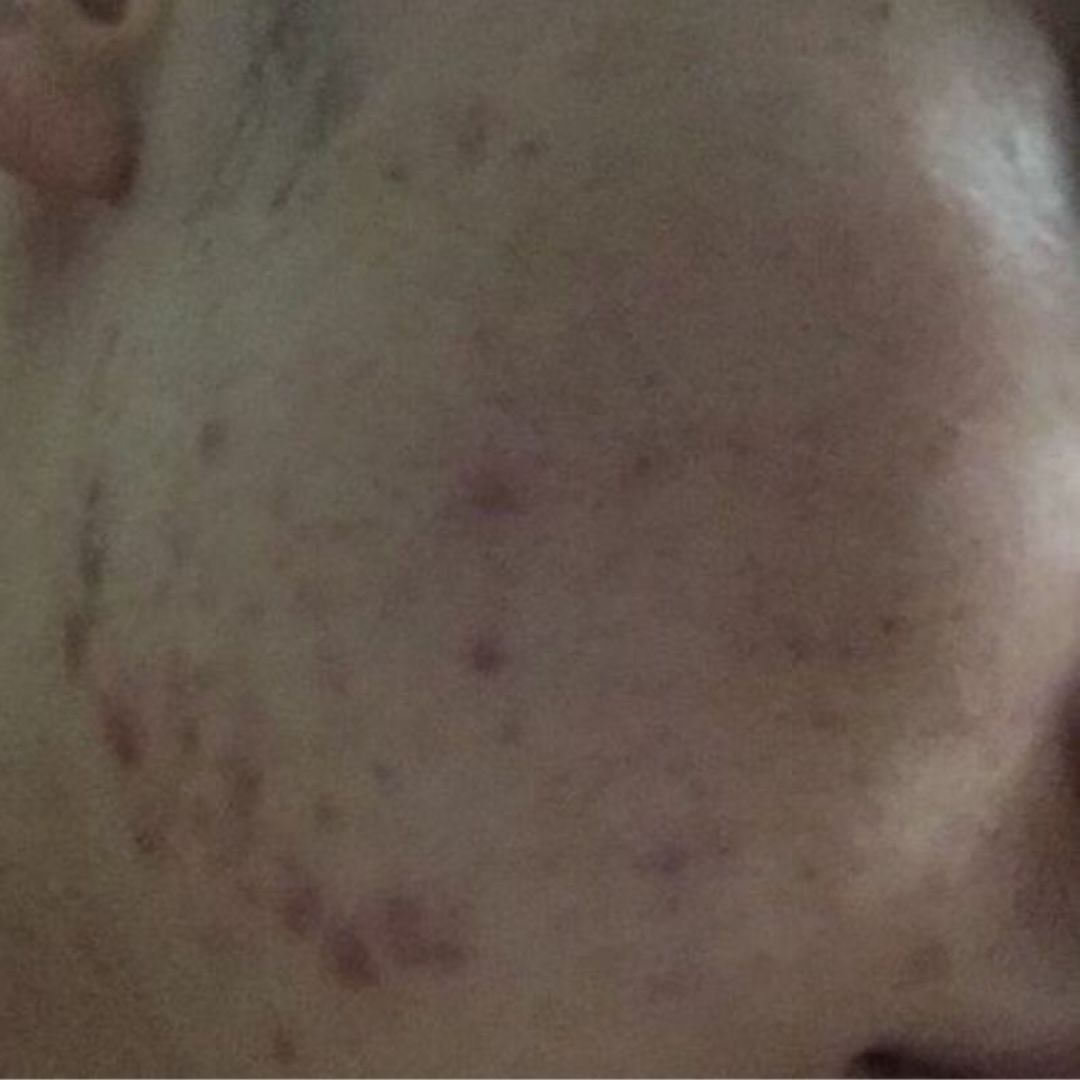 如何快速祛痘去痘印小妙招,怎样可以祛痘痘和痘印最有效