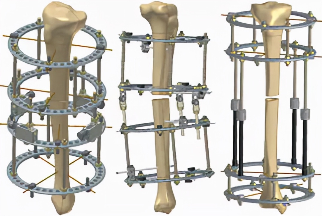 骨折固定的注意事项,骨折后需要注意哪里