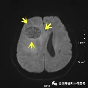 伴有脑转移了的肺癌能手术吗?