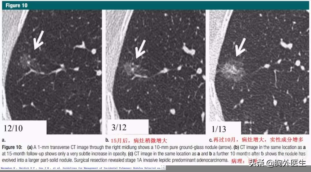 肺结节属于什么肺病,肺结节是什么病需要做化疗吗