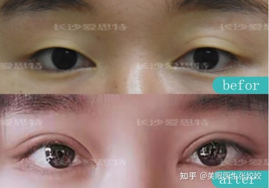 贴了双眼皮贴后的真实效果,贴双眼皮贴容易起翘