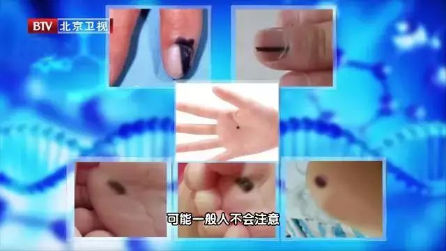 每个人身上都有很多痣么,每个人都有一颗痣好不好