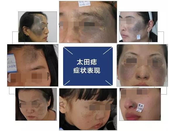 太田痣第一次激光后有效果吗,太田痣激光后掉痂多久能碰水