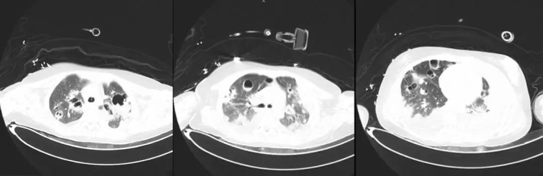 万古霉素用于mrsa的作用机制,万古霉素无效还有什么抗生素可用