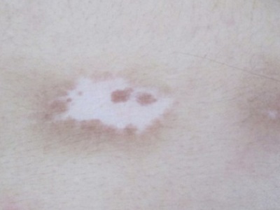 治疗白癜风，告诉你几个节省费用的小技巧