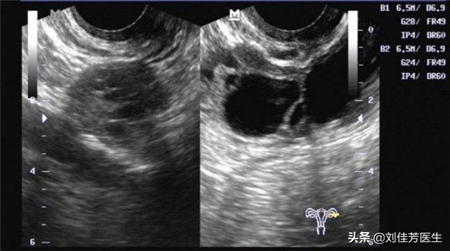 输卵管堵塞最有效的疏通方法,输卵管堵塞疏通妙招