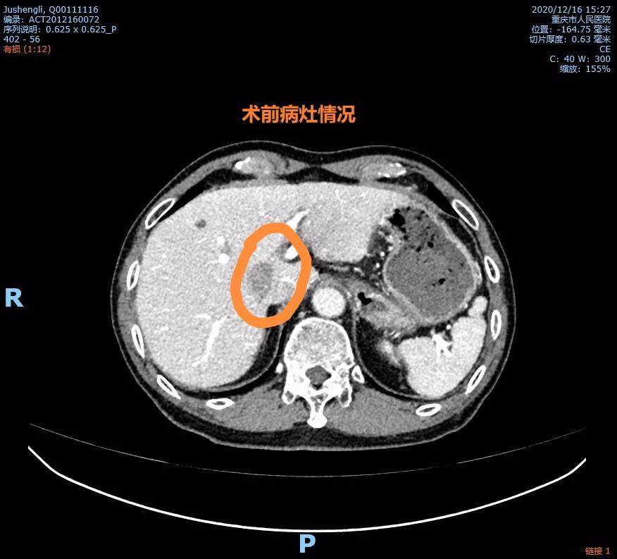 高龄老人肝癌晚期做介入治疗,72岁老人早期肝癌能手术吗