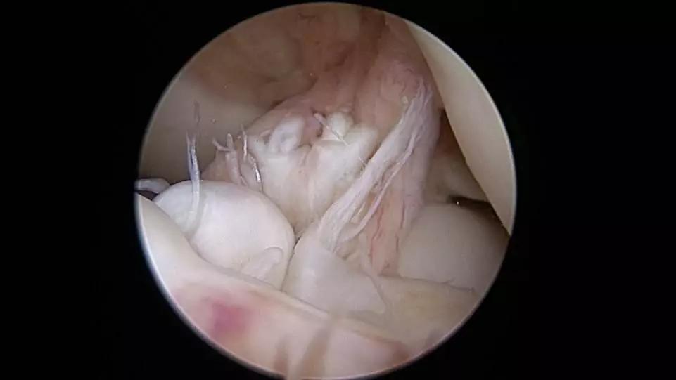 滑雪运动前叉韧带损伤康复,滑雪导致前交叉韧带断裂