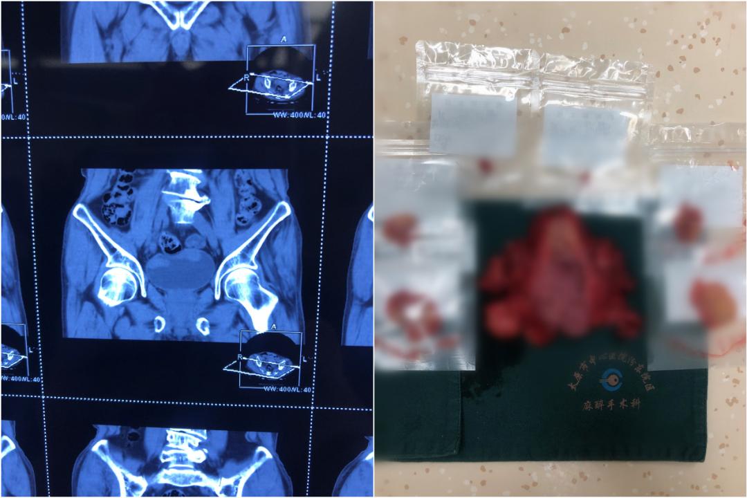 太原中心医院汾东院区泌尿科大夫,太原治疗膀胱癌最好的医院