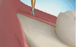 26岁男子拔智齿丧命,拔了智齿三天后突然流血怎么处理