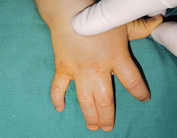 手指植皮后多久可以分指,做并指分指手术复杂吗需要植皮吗