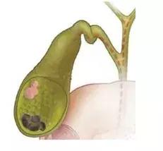 胆囊息肉会癌变吗？听医生的，医生说了算