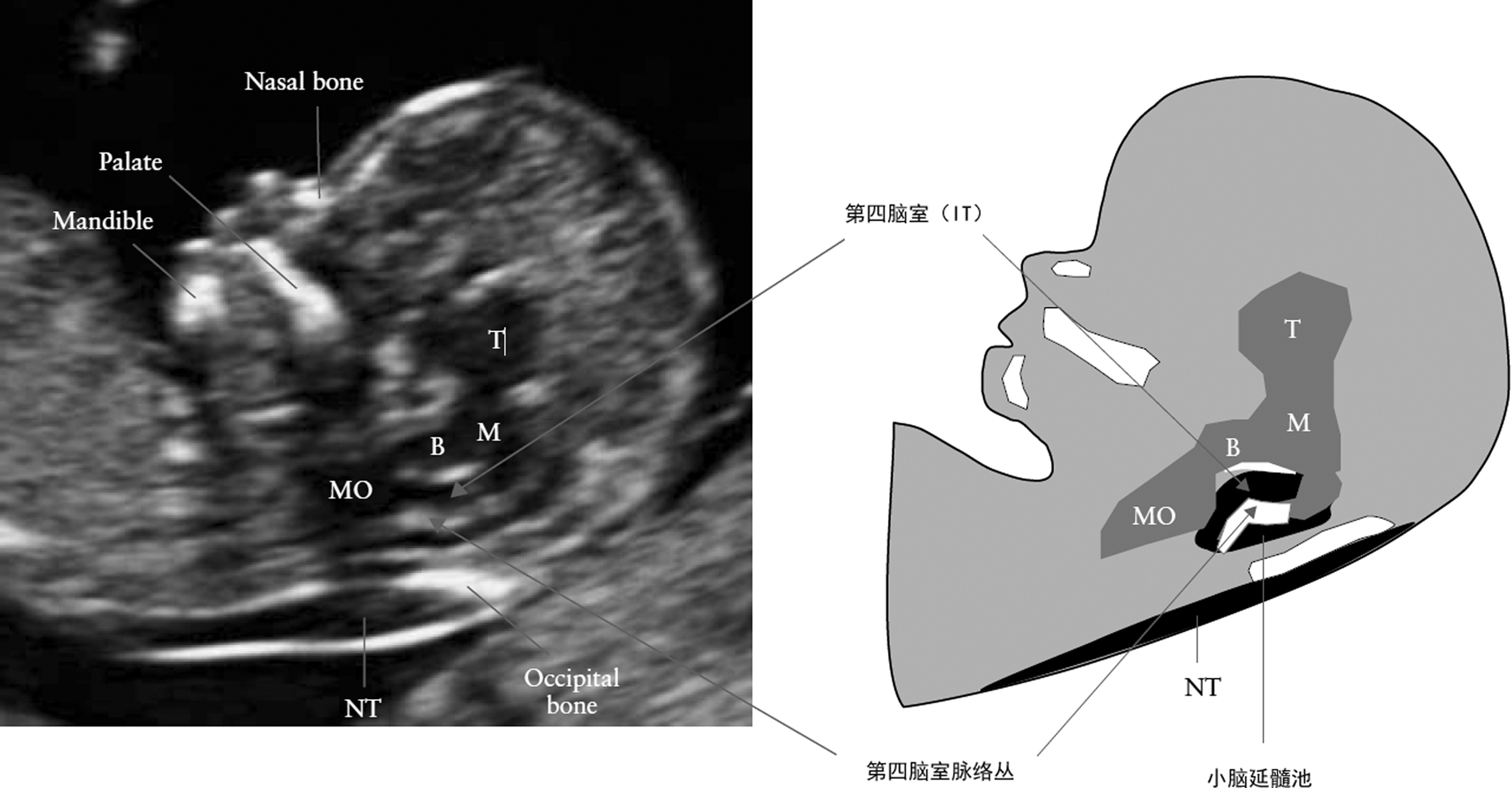 早孕期胎儿结构超声筛查是什么,胎儿早孕期超声筛查