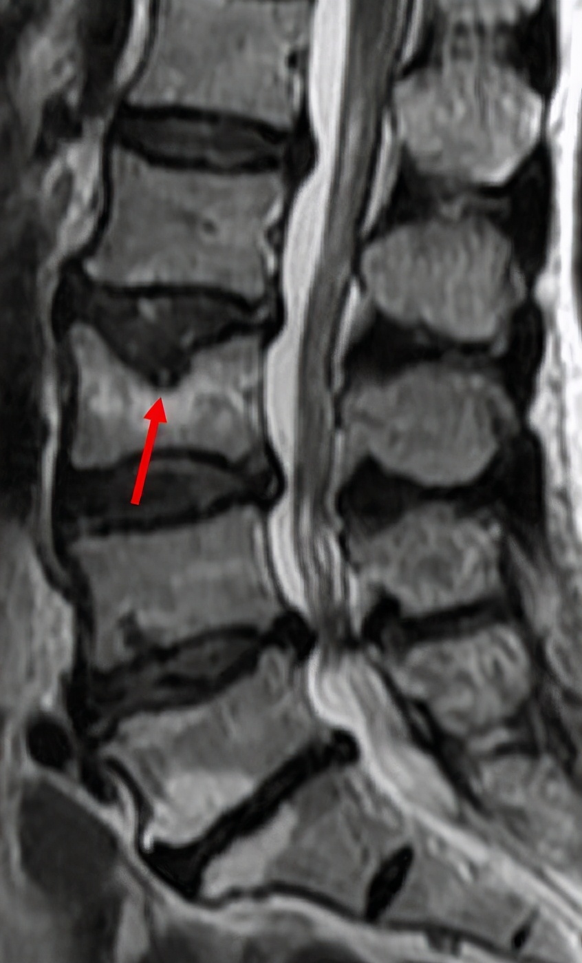 腰椎间盘突出手术后多久恢复正常,颈椎腰椎间盘突出最快的恢复办法
